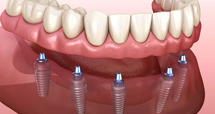 Dental implants illustration for periodontal surgery and gum contouring in Atlanta.