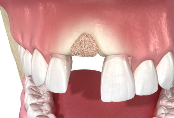 Illustration of a dental bone grafting procedure for periodontal surgery and dental implants.