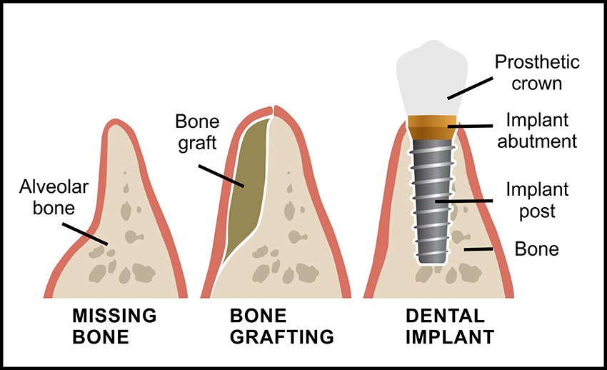 Diagram of dental implant process including bone grafting and missing bone stages.