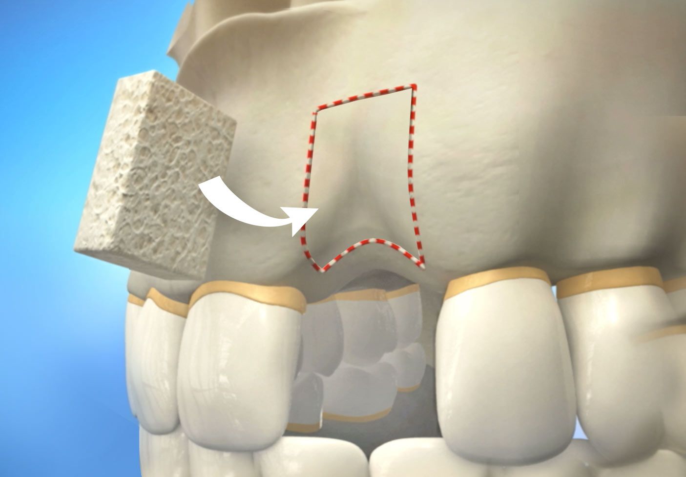 Illustration of bone grafting procedure in dentistry, highlighting periodontal surgery and dental implants in Atlanta.