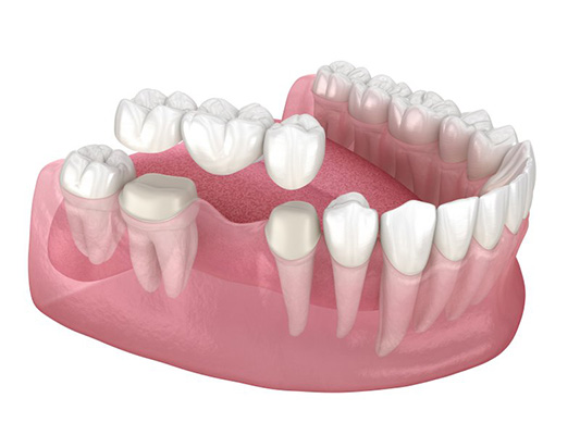 3D model of human gums and teeth, illustrating dental procedures like periodontal surgery and gum contouring."