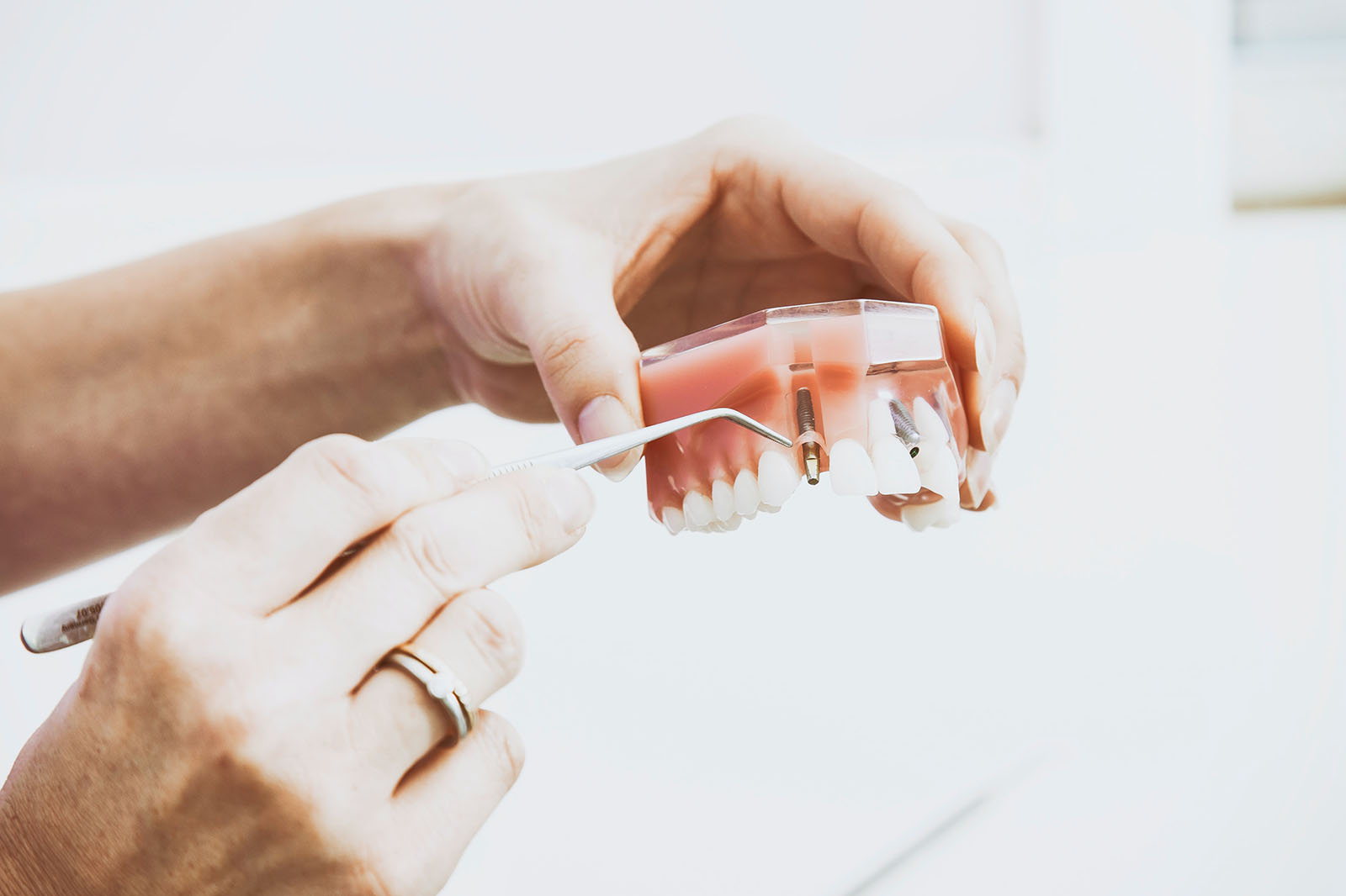 Dental model demonstration for periodontal surgery and dental implants in Atlanta.