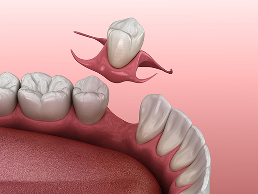 3D illustration of a dental flipper.