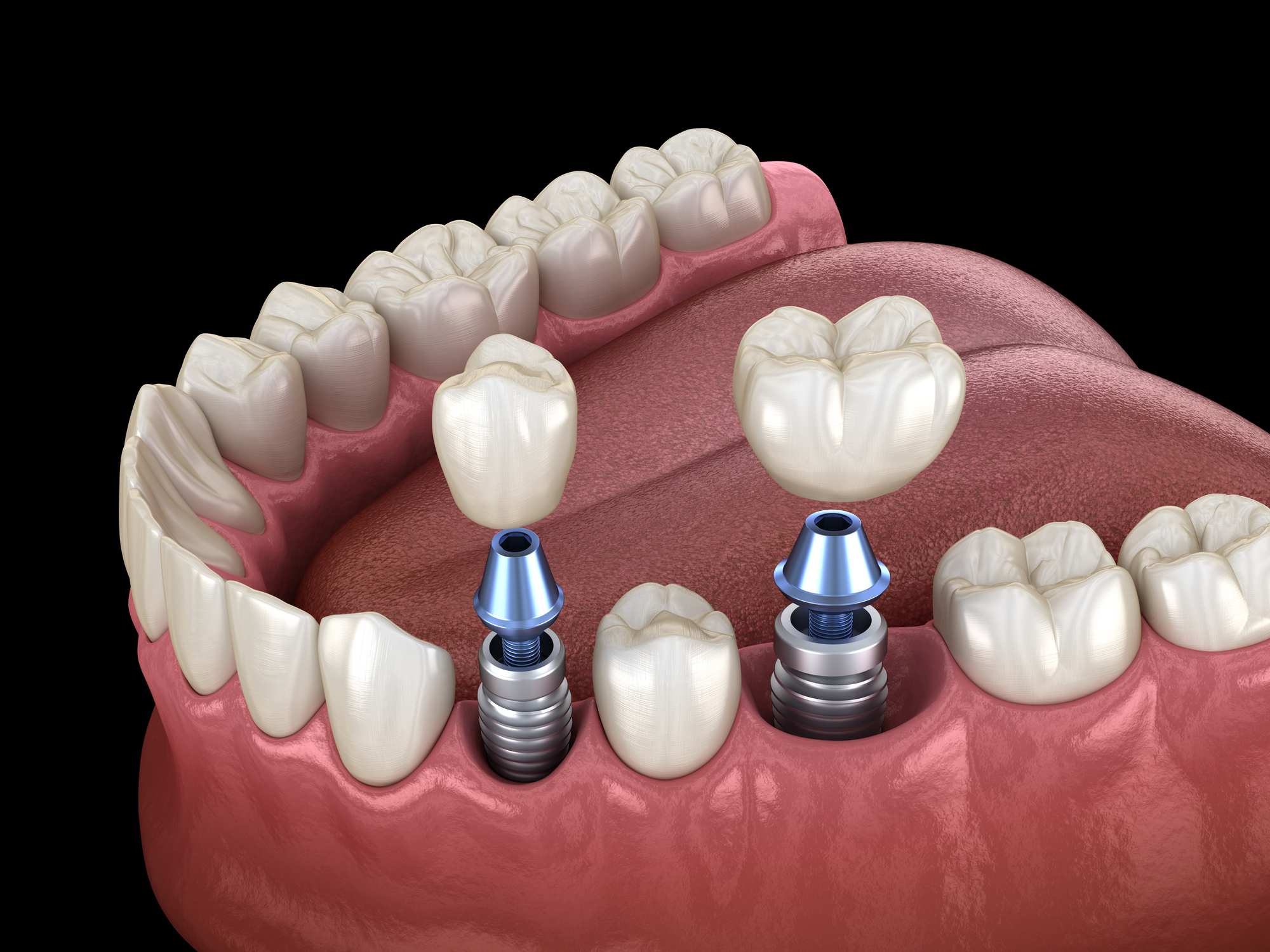 Dental implants illustration for periodontal surgery and bone grafting procedures in Atlanta.