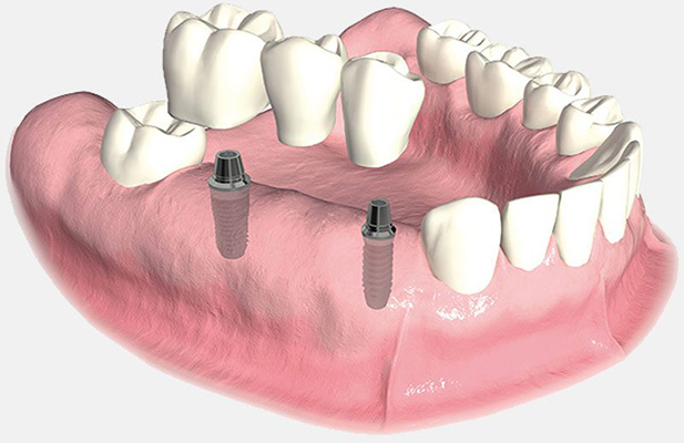 Dental implants illustration showing two implants within a lower jaw for periodontal surgery or bone grafting.