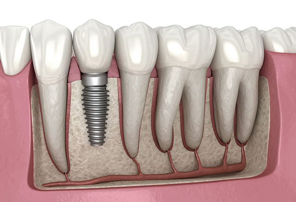 Dental implant illustration showing placement in jawbone, related to periodontal surgery and dental implants in Atlanta.