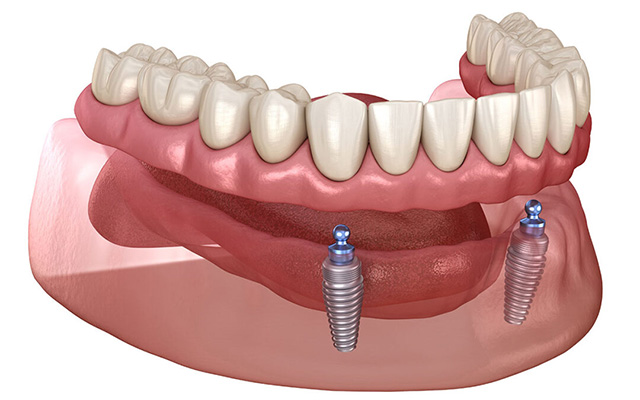 Dental implants illustration for periodontal surgery and gum contouring in Atlanta.