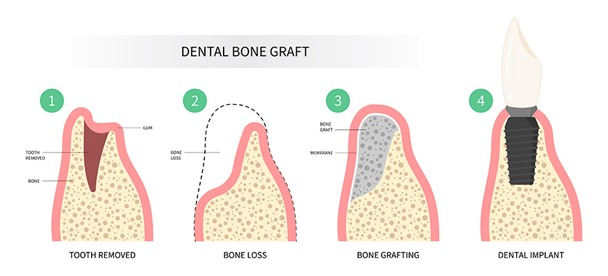 Dental bone grafting process for dental implants, showing tooth removal, bone loss, grafting, and implant placement.