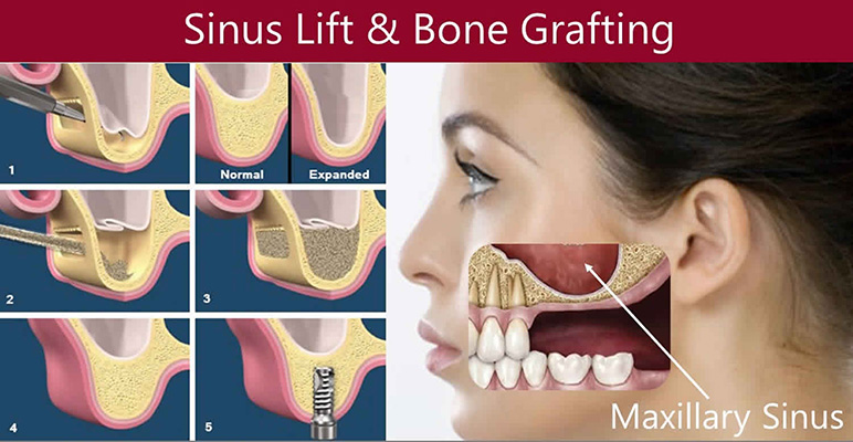 Sinus lift and bone grafting illustration with maxillary sinus and dental implant procedure steps.