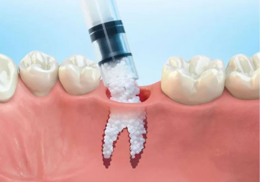 Dental bone grafting procedure illustration showing material filling a tooth socket.